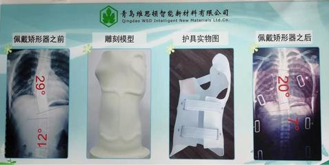 拯救“维纳斯” 「维思顿」开创数字化仿真智能矫形